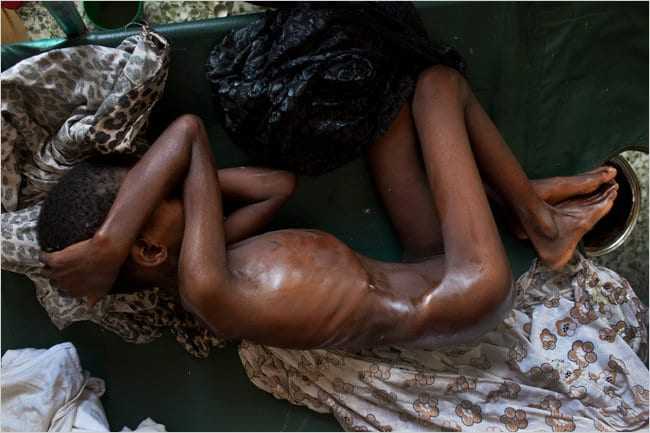 malnourished_kid_in_Mogadishu_Somalia